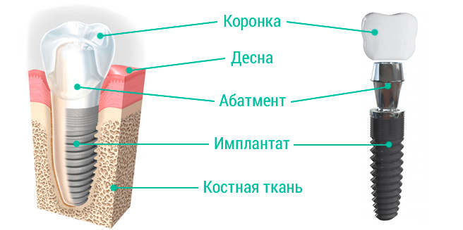 Дентальная имплантация